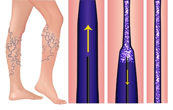 Sclerotherapy of veins in the legs - what is this procedure, the rehabilitation period, possible complications and consequences