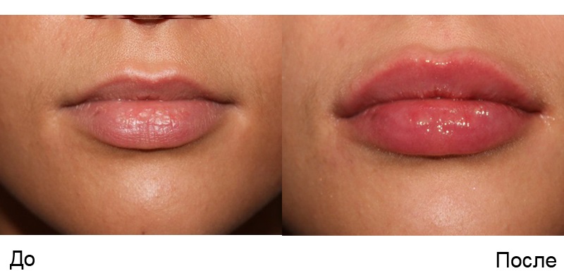 Lip augmentation with hyaluronic acid, fillers, botox, silicone, contour plastic. Photo, price, reviews