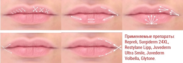 Lip augmentation with hyaluronic acid, fillers, botox, silicone, contour plastic. Photo, price, reviews