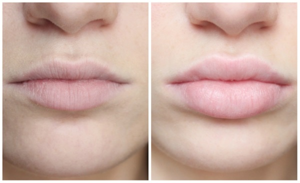 Lip augmentation with hyaluronic acid, fillers, botox, silicone, contour plastic. Photo, price, reviews