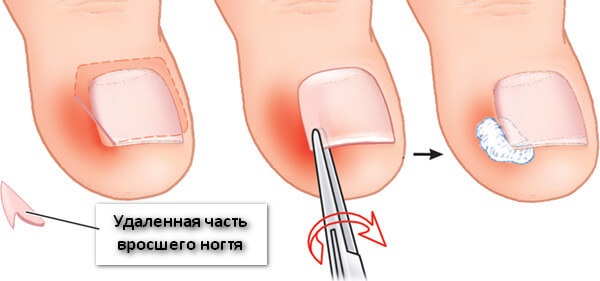 Ingrown toenail. Causes of appearance, symptoms, treatment without surgery with folk remedies, ointments, surgery