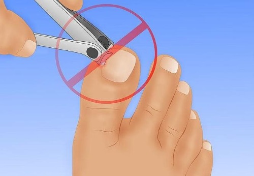 Ingrown toenail. Causes of appearance, symptoms, treatment without surgery with folk remedies, ointments, surgery