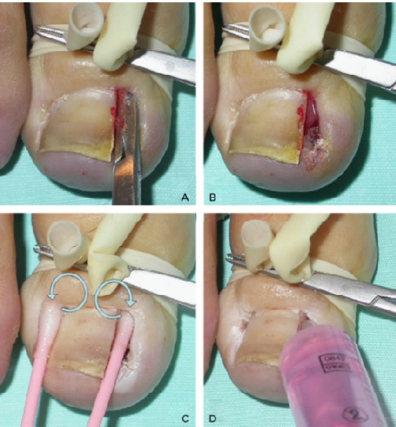 Ingrown toenail. Causes of appearance, symptoms, treatment without surgery with folk remedies, ointments, surgery