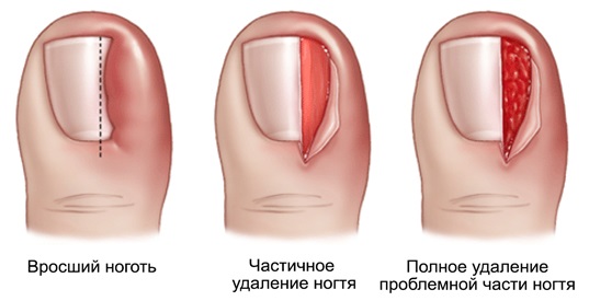 Ingrown toenail. Causes of appearance, symptoms, treatment without surgery with folk remedies, ointments, surgery