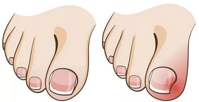 Ingrown toenail. Causes of appearance, symptoms, treatment without surgery with folk remedies, ointments, surgery