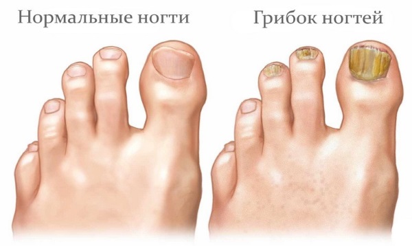 Ingrown toenail. Causes of appearance, symptoms, treatment without surgery with folk remedies, ointments, surgery