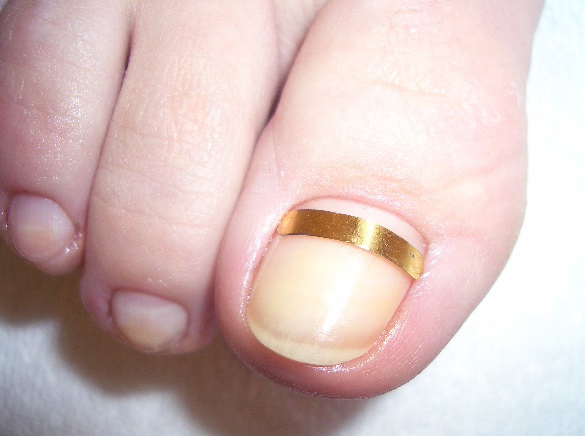 Ingrown toenail. Causes of appearance, symptoms, treatment without surgery with folk remedies, ointments, surgery