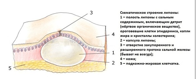 How to get rid of wen on the eyelids with folk remedies, ointments.Causes of white, yellow xanthelasm