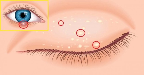 How to get rid of wen on the eyelids with folk remedies, ointments. Causes of white, yellow xanthelasm