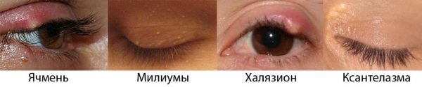 How to get rid of wen on the eyelids with folk remedies, ointments. Causes of white, yellow xanthelasm