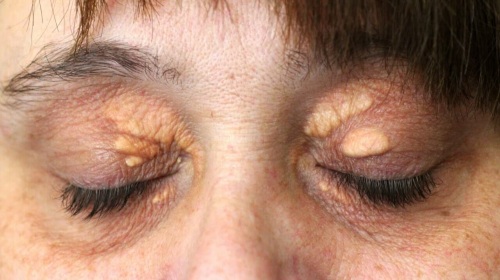 How to get rid of wen on the eyelids with folk remedies, ointments. Causes of white, yellow xanthelasm