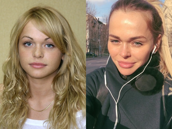 Anna Khilkevich before and after plastic surgery, height, weight, body parameters. Photo, biography