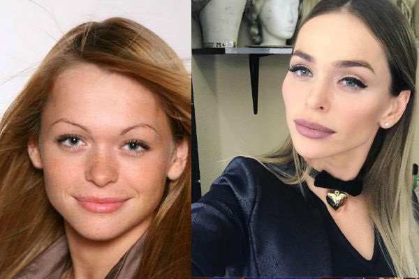 Anna Khilkevich before and after plastic surgery, height, weight, body parameters. Photo, biography