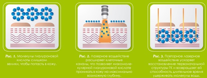 Biorevitalization of the face.What is better, what is the difference, prices: Aquashine, Ial System, Yalupro, Filorga, Princess Rich