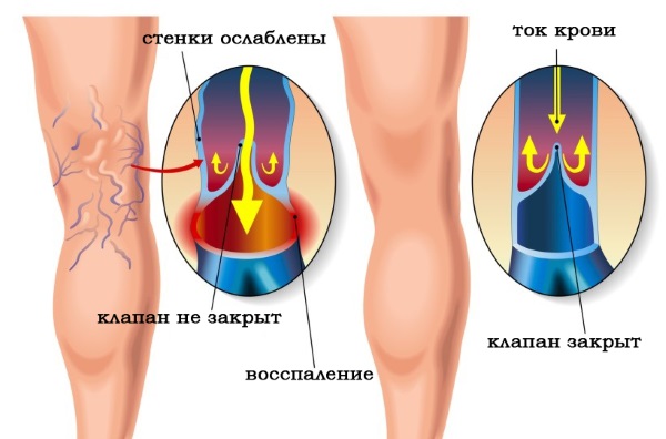 Endosphere therapy - what is it, massage reviews, results, price. Cellulite correction devices