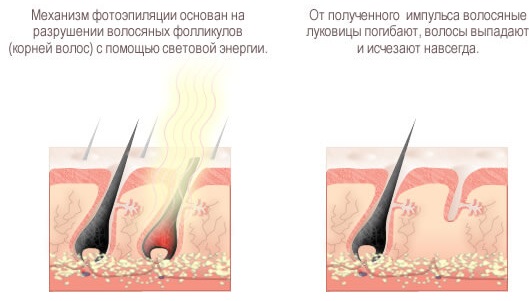 Epilation and depilation - what's the difference: sugar, wax, creams, strips for the intimate area, laser depilation in the salon and at home