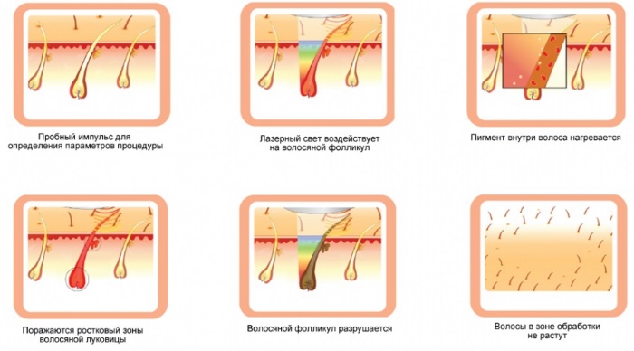 Epilation and depilation - what is the difference: sugar, wax, creams, strips for the intimate area, laser depilation in the salon and at home