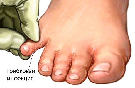 How to get rid of foot odor effectively. Best remedies in pharmacies, causes and treatments for sweating