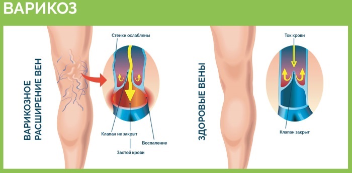 Come bruciare rapidamente il grasso sulla pancia e sui fianchi di una donna a casa: esercizi, preparativi, impacchi, massaggi