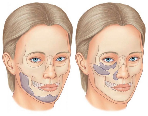 How to remove flews on the face, restore the oval: exercises, procedures in cosmetology, gymnastics, lifting