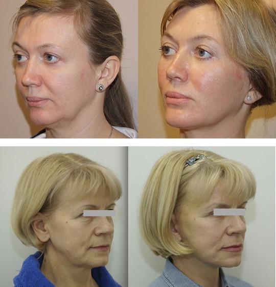 How to remove flews on the face, restore the oval: exercises, procedures in cosmetology, gymnastics, lifting