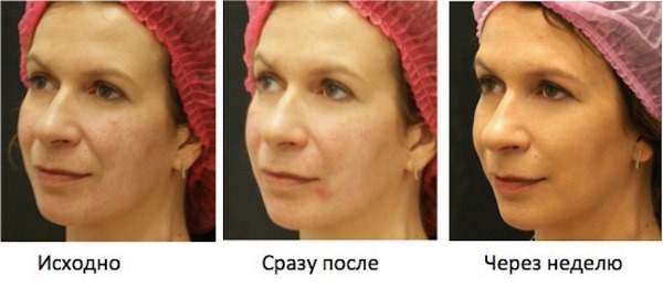 How to remove flews on the face, restore the oval: exercises, procedures in cosmetology, gymnastics, lifting