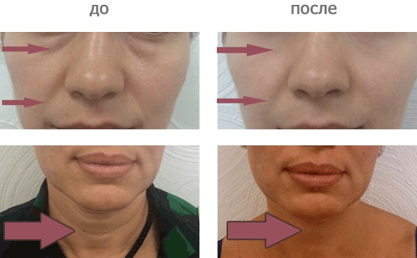 Carboxytherapy - what is it for a face in cosmetology: non-injection, non-invasive, injection. Before and after photos, price, reviews