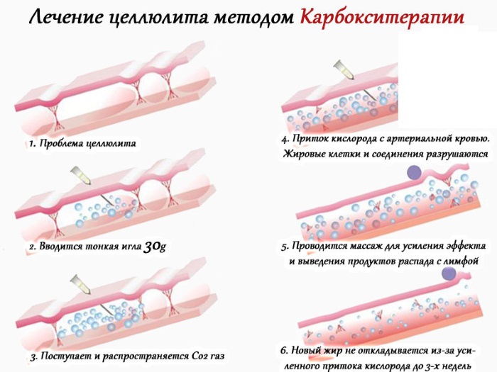 Carboxytherapy - what is it for a face in cosmetology: non-injection, non-invasive, injection. Before and after photos, price, reviews