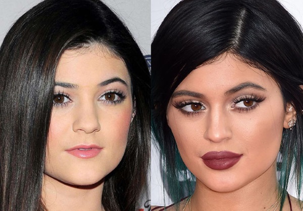 Kylie Jenner before and after plastic surgery: photos without makeup, photoshop, in a swimsuit, pregnant. How old, height, parameters, biography