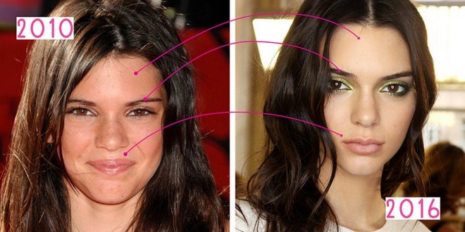 Kendall Jenner. Photos before and after plastic surgery, in full growth. Operation on lips, buttocks, eyelids, nose correction