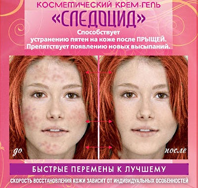 Acne spot cream: red, dark, stagnant, whitening at the pharmacy. Most effective: Sledocid, Klirvin, Panthenol, Badiaga