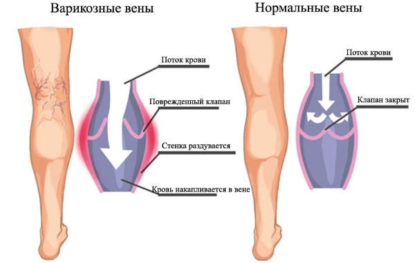 Zorka cream. Instructions for use for people from cracked heels, with varicose veins, psoriasis, heel spurs, dermatitis, eczema, hemorrhoids