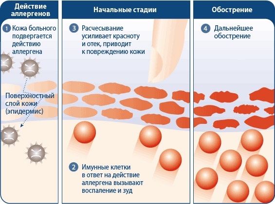 Zorka cream. Instructions for use for people from cracked heels, with varicose veins, psoriasis, heel spurs, dermatitis, eczema, hemorrhoids