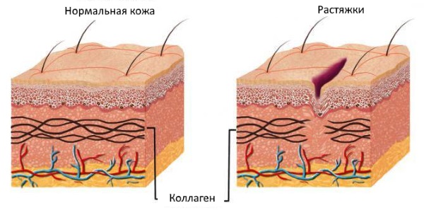 Zorka cream. Instructions for use for people from cracked heels, with varicose veins, psoriasis, heel spurs, dermatitis, eczema, hemorrhoids