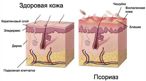 Zorka cream. Instructions for use for people from cracked heels, with varicose veins, psoriasis, heel spurs, dermatitis, eczema, hemorrhoids