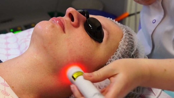 Laser biorevitalization of the face with hyaluronic acid. What is it, reviews of cosmetologists. Price for 1 procedure, how many procedures need to be done