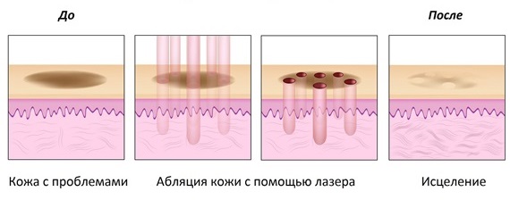 Laser nanoperforation of the face, stretch marks, scars, post-acne. Reviews of doctors, contraindications, consequences