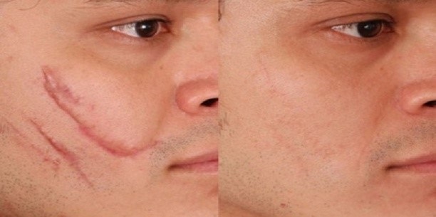 Laser nanoperforation of the face, stretch marks, scars, post-acne. Reviews of doctors, contraindications, consequences