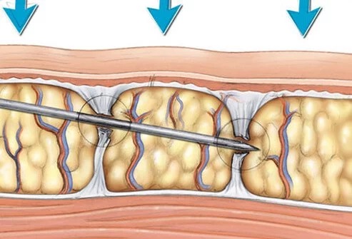 Lipofilling of the mammary glands. Reviews of patients, surgeons, the price of the increase, photos before and after