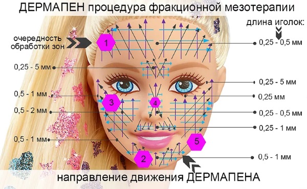 Microneedling: what it is, how it is done. Devices, contraindications, price of the procedure, reviews