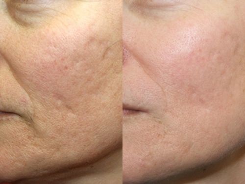 Microneedling: what it is, how it is done. Devices, contraindications, price of the procedure, reviews