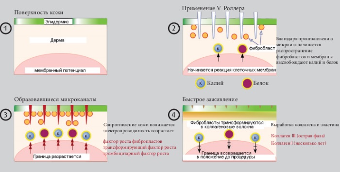 Microneedling: what it is, how it is done. Devices, contraindications, price of the procedure, reviews