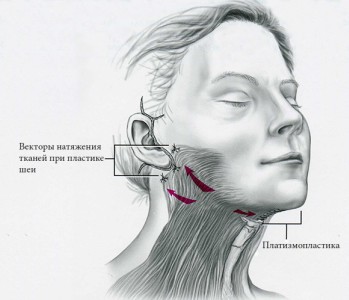 Platysmoplasty - what is it, types: medial, Hollywood, corset, median, endoscopic. Reviews and prices about the procedure