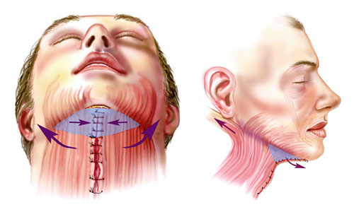 Platysmoplasty - what is it, types: medial, Hollywood, corset, median, endoscopic. Reviews and prices about the procedure