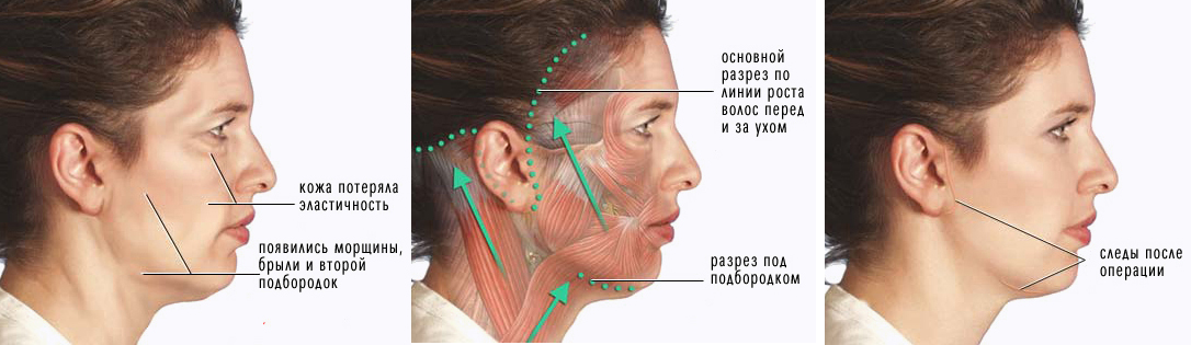 Platysmoplasty - what is it, types: medial, Hollywood, corset, median, endoscopic. Reviews and prices about the procedure