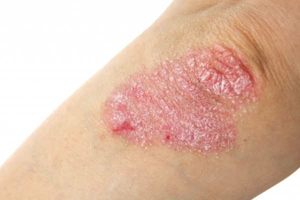 Dry skin on the elbows.Causes and treatment with folk remedies, ointments, drugs in tablets