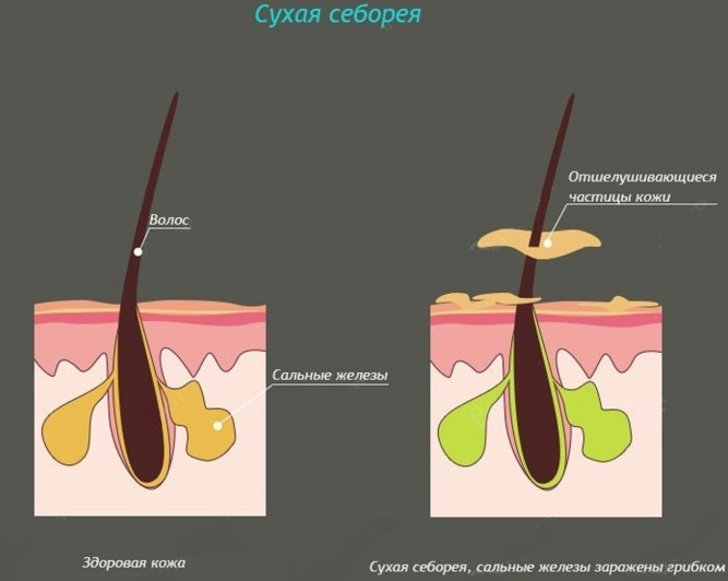 Pasta Sulsena. Istruzioni per l'uso per la crescita dei capelli, contro la forfora, la caduta dei capelli, l'untuosità