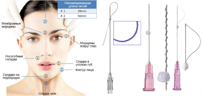 Threadlifting with 3D mesothreads for face, lips, forehead, abdomen. Before and after photos, reviews, price of the procedure