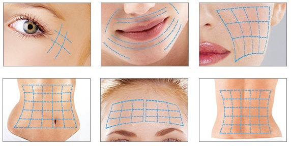 Threadlifting with 3D mesothreads for face, lips, forehead, abdomen. Before and after photos, reviews, price of the procedure