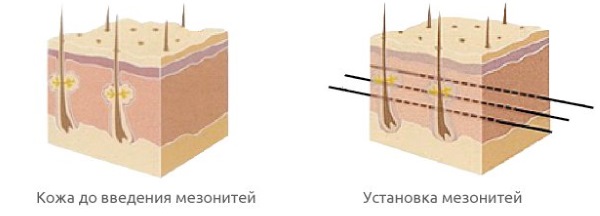 Threadlifting with 3D mesothreads for face, lips, forehead, abdomen. Before and after photos, reviews, price of the procedure